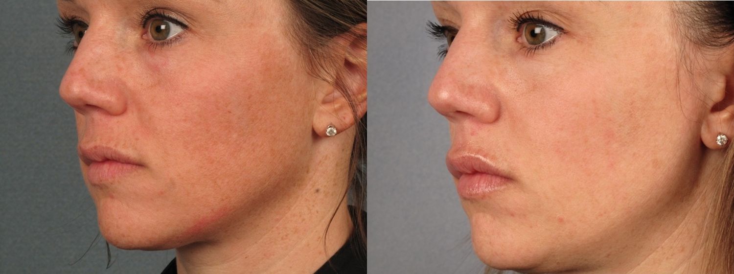 Before & after shot of a woman's face as she's receiving treatment for melasma in Waterloo